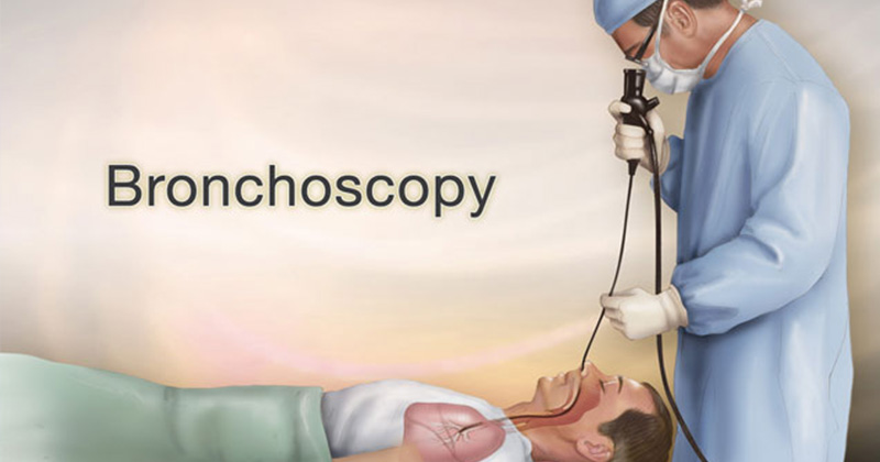 Bronchoscopy